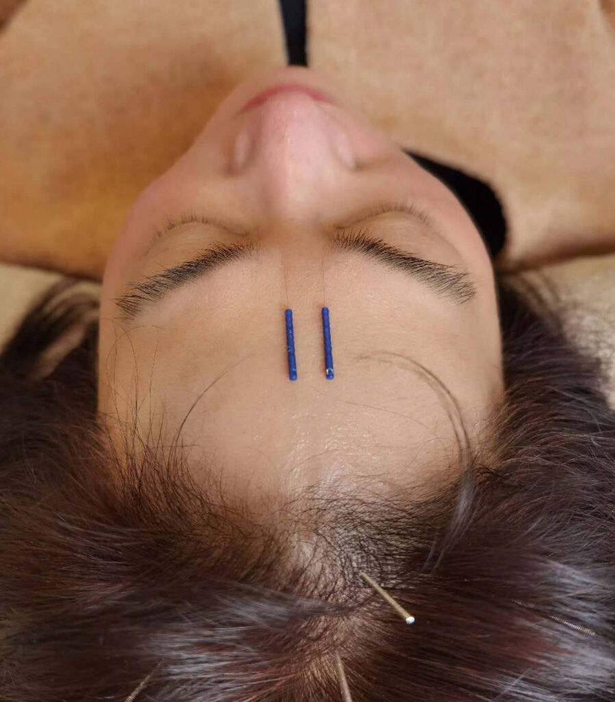 Cosmetic Acupuncture