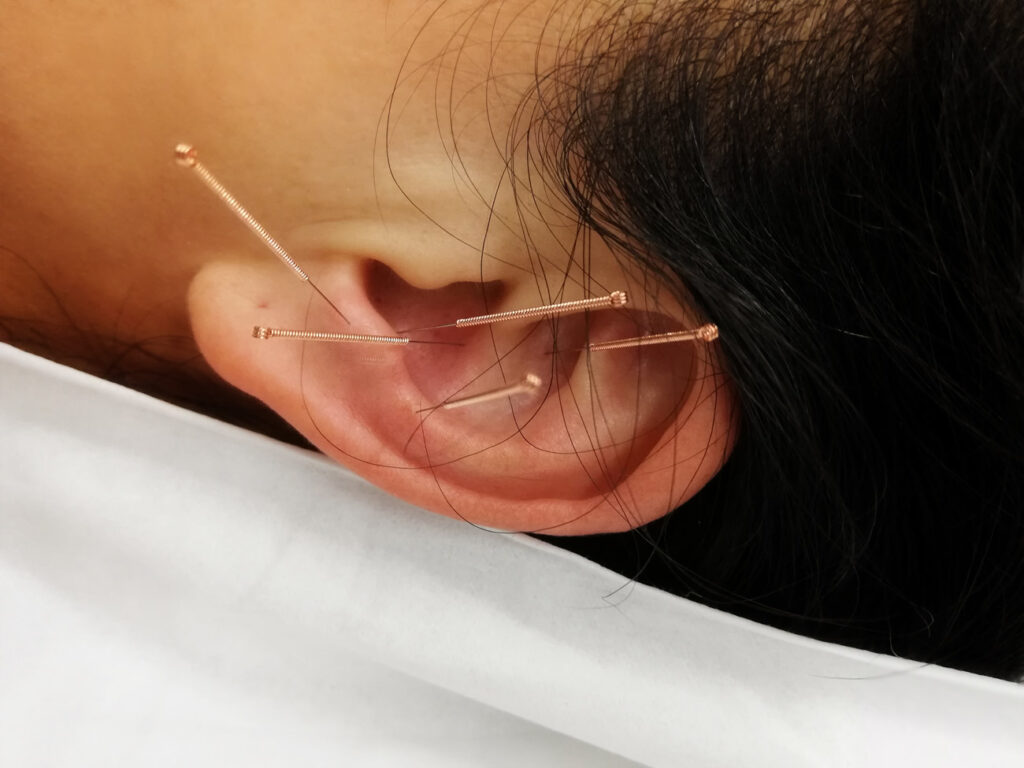 Oncology acupuncture assist with cancer patients
